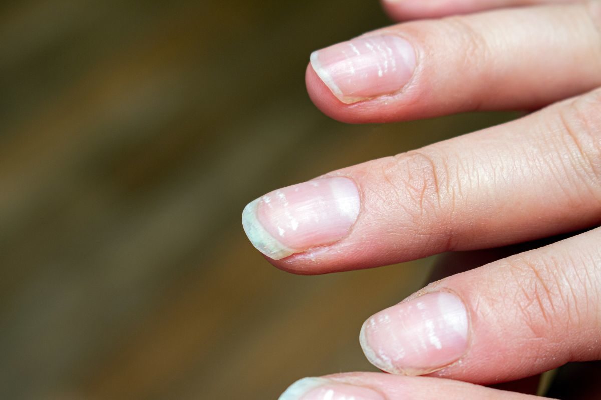 Nail Care Tips: Say Goodbye to White Spots in Just 3 Days